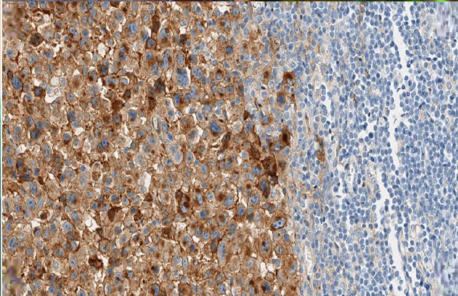 Sarcoma